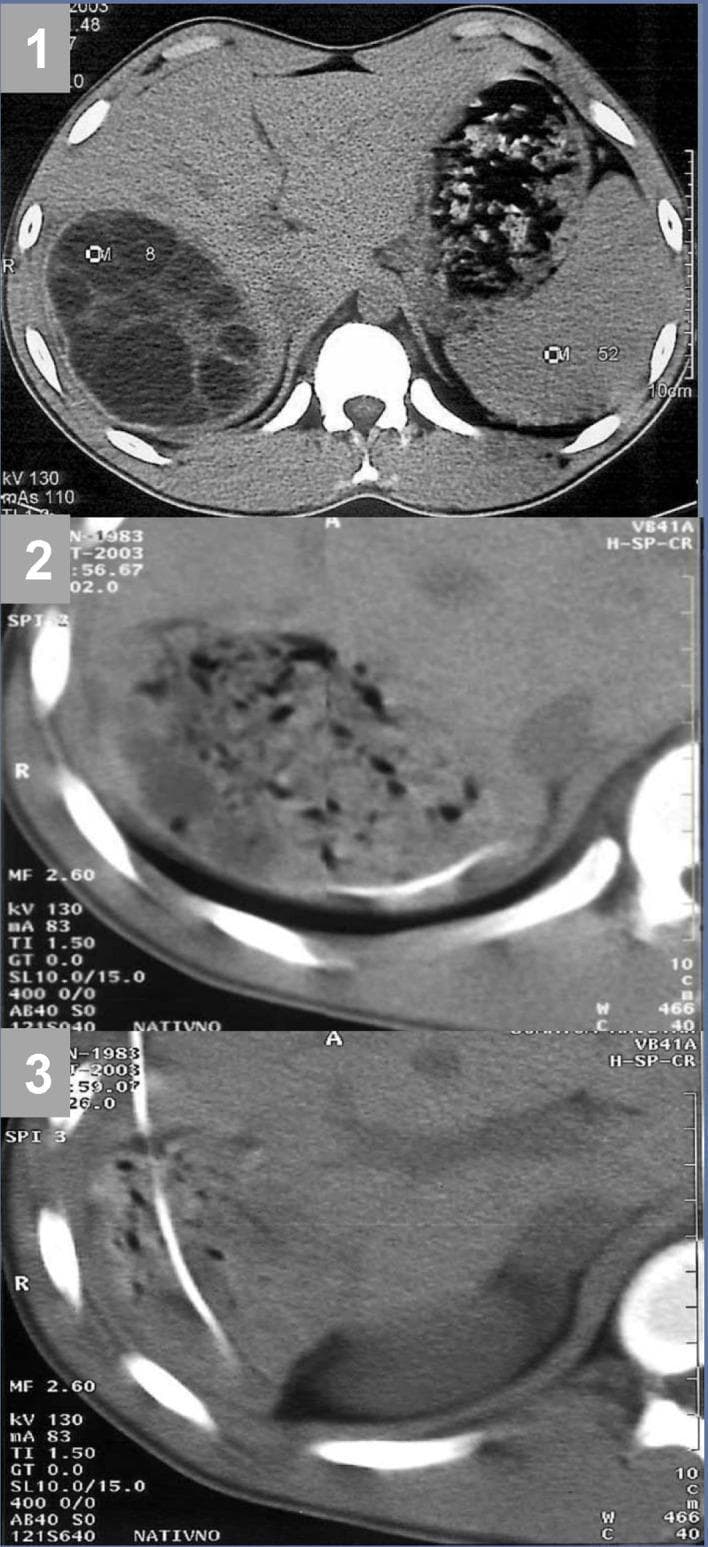 Diagnostic axial CT scans of the abdomen demonstrating a hepatic hydatid cyst (Echinococcus granulosus) and its management via the PAIR (Puncture, Aspiration, Injection, and Re-aspiration) technique. Frame (1) shows a large, well-circumscribed, multivesicular hydatid cyst in the right hepatic lobe, characterized by internal septations and multiple daughter cysts (Gharbi stage 3). Frame (2) displays the cyst cavity post-intervention, showing collapse and heterogeneous internal density as the vesicular fluid is removed and necrotic tissue remains. Frame (3) reveals a radiopaque percutaneous drainage catheter traversing the liver parenchyma with its tip positioned within the residual cyst cavity to facilitate evacuation of debris and disintegrated membranes. This series illustrates the interventional radiological approach to cystic echinococcosis, highlighting the transition from a tense multilocular lesion to a collapsed cavity undergoing drainage. Educational focus is on diagnostic imaging of parasitic liver disease and the visual confirmation of successful catheter placement during minimally invasive treatment.