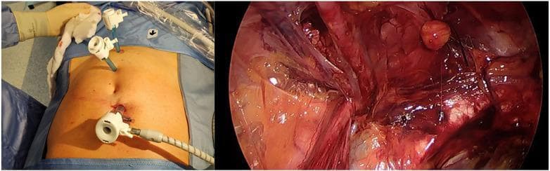 A composite medical image featuring a clinical photograph and a laparoscopic view demonstrating a Totally Extraperitoneal (TEP) inguinal hernia repair procedure. The left panel shows the external abdominal view of a supine patient with surgical draping. Three trocars are visible: one 10 mm optical trocar placed infraumbilically with connected insufflation tubing, and two operative trocars positioned superiorly along the midline. The right panel displays the internal laparoscopic view of the preperitoneal space during inguinal dissection before mesh placement. The surgical field highlights vascularized tissue, anatomical planes, and a prominent reddish-brown structure representing a hernia sac or landmark within the inguinal region. This image illustrates the E-TEP (Enhanced View Totally Extraperitoneal) technique, focusing on trocar disposition to optimize working space and visual access to the inguinal anatomy for hernia management.