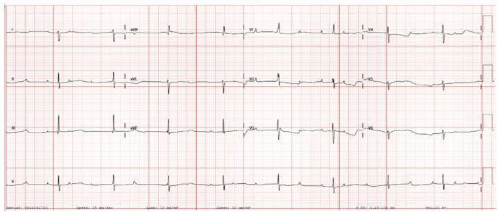 This diagnostic image is a 12-lead postnatal electrocardiogram (ECG) demonstrating Third-Degree (Complete) Atrioventricular (AV) Block. The tracing shows a clear lack of conduction between the atria and ventricles, evidenced by complete AV dissociation. P waves are present and occur at a regular, faster atrial rate of approximately 125 bpm, while the QRS complexes appear at a much slower, independent ventricular escape rate of approximately 52 bpm. The P-R intervals are highly variable as the P waves 'march through' the QRS complexes without initiating them. The QRS complexes exhibit a relatively narrow morphology for a ventricular escape rhythm, suggesting a junctional or high-septal origin. This ECG is a classic representation of congenital or neonatal complete heart block, often associated with maternal autoimmune conditions such as anti-Ro/SSA or anti-La/SSB antibodies. It serves as a key educational example of severe bradycardia and AV conduction failure in a neonatal clinical context.
