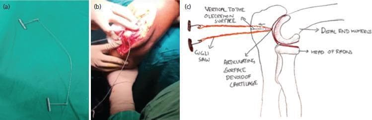 This composite image illustrates the surgical use of a Gigli saw for performing an olecranon osteotomy. Panel (a) is a photograph of the instrument itself, showing a flexible, twisted wire cable made of high-tensile stainless steel, attached to two T-shaped handles designed for a two-handed to-and-fro cutting motion. Panel (b) provides an intra-operative clinical photograph showing the surgical field of the elbow. A surgeon’s gloved hands are visible manipulating the Gigli saw, which has been passed through the soft tissue to interface with the bone. The operative area shows exposed muscle and bone with appropriate surgical retraction. Panel (c) is a labeled anatomical diagram depicting the path of the saw in relation to the distal humerus, the head of the radius, and the semilunar notch of the olecranon. The diagram highlights the 'inside-out' technique, where the saw is positioned against the articulating surface of the sigmoid notch (devoid of cartilage) and moved vertically to the surface of the olecranon to create a clean, linear osteotomy for joint exposure during distal humerus fracture fixation.