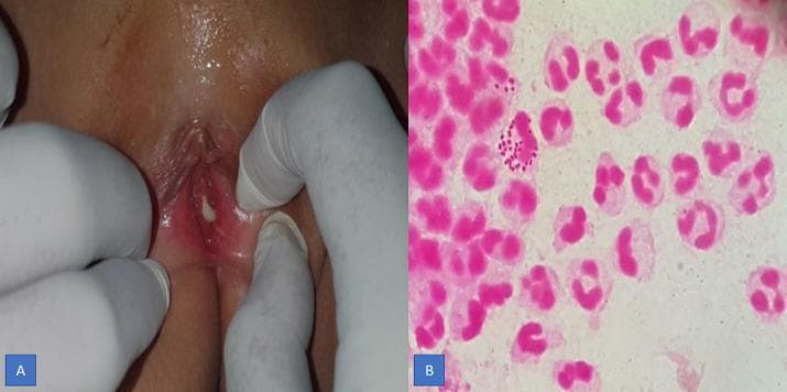 This composite educational image illustrates the clinical and laboratory findings of gonococcal vaginitis. Figure A is a clinical photograph of the vulvar region during a venereological examination. It demonstrates significant vulvar erythema (redness) and a prominent, greenish-yellow purulent discharge emanating from the vaginal introitus. Figure B is a high-power light microscopy image of a Gram-stained vaginal secretion. The smear reveals a dense inflammatory infiltrate composed primarily of polymorphonuclear (PMN) leukocytes. Within the cytoplasm of several PMN cells, characteristic Gram-negative (pink-stained), bean-shaped diplococci are clearly visible, representing Neisseria gonorrhoeae. Some diplococci are also observed in the extracellular space. This comparison demonstrates the correlation between gross clinical symptoms (purulent discharge and inflammation) and the diagnostic microbiological evidence (intracellular Gram-negative diplococci) used to confirm a diagnosis of gonorrhea.
