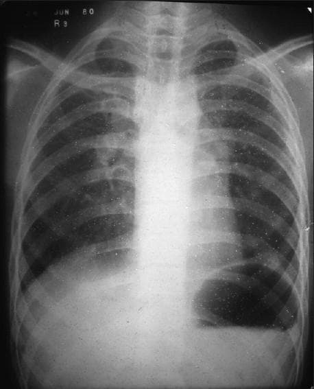 This diagnostic image is a posteroanterior (PA) chest X-ray illustrating classic features of stage II sarcoidosis. The primary finding is significant bilateral hilar lymphadenopathy, characterized by symmetrical enlargement and lobulated contours of both lung roots. Additionally, there is prominent soft tissue density in the left paratracheal region, indicating paratracheal lymphadenopathy. The lung parenchyma exhibits a diffuse reticulonodular pattern, with granular infiltrates most concentrated in the upper and middle lung zones bilaterally. These small, ill-defined opacities represent granulomatous inflammation within the interstitial spaces. The combination of symmetric hilar nodes and upper-lobe predominant parenchymal changes is highly characteristic of sarcoidosis. The image serves as a clinical reference for pulmonary manifestations of systemic granulomatous disease and the radiological assessment of mediastinal lymphadenopathy.