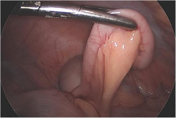 This intraoperative laparoscopic photograph shows a grossly normal vermiform appendix in a pediatric patient. The imaging modality is diagnostic laparoscopy, capturing the right lower quadrant of the abdomen. The appendix is held by a surgical grasper, revealing a smooth, glistening serosal surface with a healthy pinkish-tan hue. There are no visual markers of acute appendicitis, such as luminal distension, erythema, edema, or fibrinopurulent exudate. The mesoappendix and surrounding mesenteric fat appear unremarkable, lacking the hyperemia or 'fat stranding' characteristic of acute inflammation. This image serves as a clinical comparison for medical students to distinguish a healthy appendix from one with inflammatory changes, such as those seen in typical acute appendicitis or cases mimicking it, like Multi-system Inflammatory Syndrome in Children (MIS-C). Educational focus is on the laparoscopic appearance of visceral abdominal anatomy and the visual exclusion of transmural inflammation during a surgical workup for acute abdominal pain.