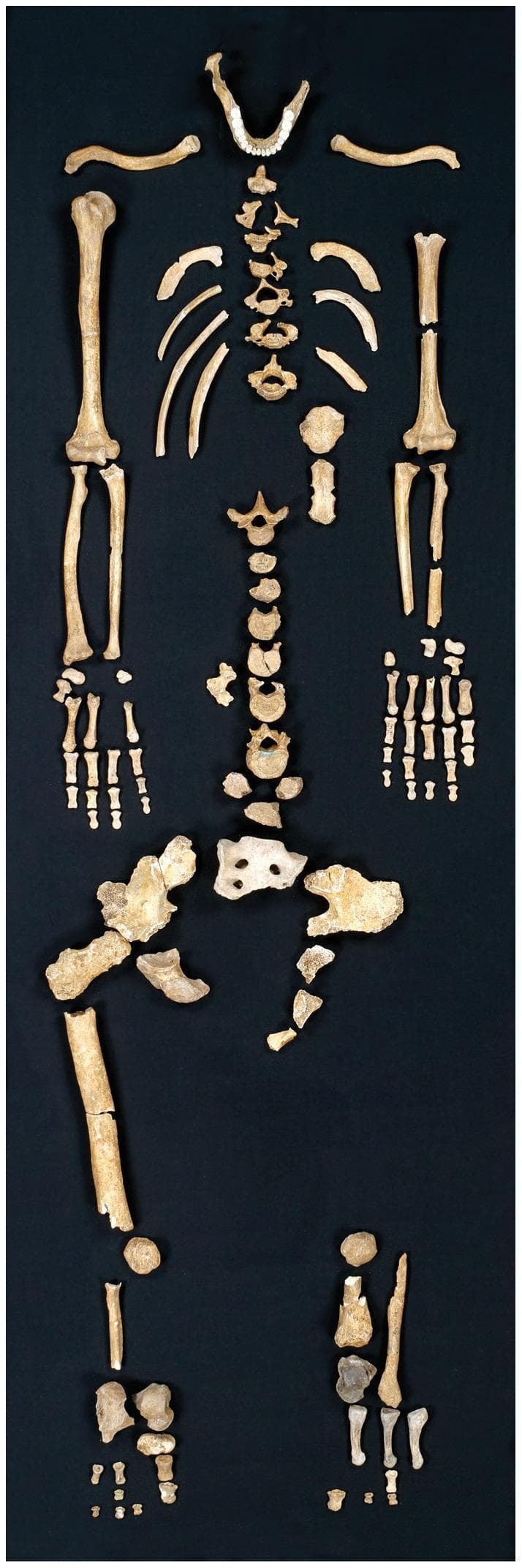 This clinical photograph displays the Regourdou 1 skeleton, an archaeologically significant partial Neanderthal skeleton laid out in an anatomical approximation on a dark background. The axial skeleton is represented by a mandible with a complete set of erupted teeth, a segmented vertebral column showing various cervical, thoracic, and lumbar vertebrae, and a partial superior sacrum. The thoracic cage includes bilateral clavicles and several fragmented ribs. The appendicular skeleton features both upper and lower limbs. The upper limbs include the humeri, radii, ulnae, and relatively complete disarticulated hands. The lower skeleton comprises fragmented bilateral ilia (pelvic girdle), a prominent right femur shaft, and scattered pedal elements. Many bones exhibit taphonomic changes, including significant fragmentation and disarticulation. Preservation is asymmetrical, with the right upper limb showing greater completeness than the left. This specimen is used in paleoanthropology to study Neanderthal anatomy, biomechanical stress (through cortical bone analysis), and behavioral traits such as handedness based on dental wear patterns.