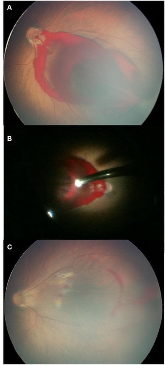 This composite of clinical ophthalmological images illustrates the management and surgical resolution of a dense pre-macular retinal hemorrhage (RH) in a newborn. Panel A shows a preoperative fundus photograph featuring a large, dense, boat-shaped subhyaloid or preretinal hemorrhage located at the posterior pole. The hemorrhage is opaque and completely obscures the underlying macula and optic disc details, presenting a significant threat to visual development. Panel B provides an intraoperative view during a lens-sparing vitrectomy, demonstrating the microsurgical instruments used to evacuate the localized blood. Panel C displays the postoperative fundus appearance one month after surgery, showing a clear macula with successful restoration of retinal visibility. Residual light blood staining and pigmentary changes are visible, but the primary obstructive mass has been cleared. This series demonstrates the clinical progression from acute obstructive hemorrhage to surgical clearance in pediatric ophthalmology, highlighting the importance of timely intervention to prevent amblyopia in cases of dense macular-impacting hemorrhages.