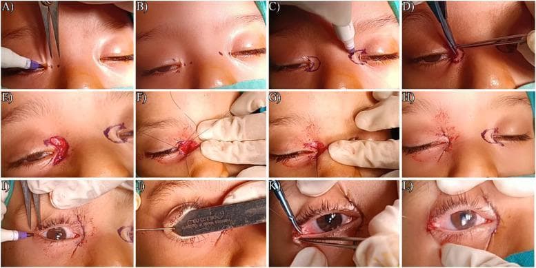 This composite of clinical photographs illustrates a 12-step surgical sequence (A-L) for the simultaneous correction of epicanthus and telecanthus, typically associated with Blepharophimosis-ptosis-epicanthus inversus syndrome (BPES). Panels A-C show the preoperative marking of the C-U medial canthoplasty, utilizing points A-D to delineate the desired horizontal palpebral fissure length (HPFL). Panel D demonstrates the excision of skin and underlying orbicularis oculi muscle. Panels E-G depict the exposure, plication, and shortening of the medial canthal tendon to reduce inter-isthmus distance. Panel H shows the completed medial wound closure. The final row (I-L) focuses on lateral canthoplasty, showing the marking of the lateral skin, surgical widening of the lateral canthal wound to lengthen the HPFL, and suturing of the undermined conjunctiva to form a sharp lateral canthal angle. This educational material highlights the specialized oculoplastic techniques required to achieve anatomical correction of both the medial and lateral ocular structures.