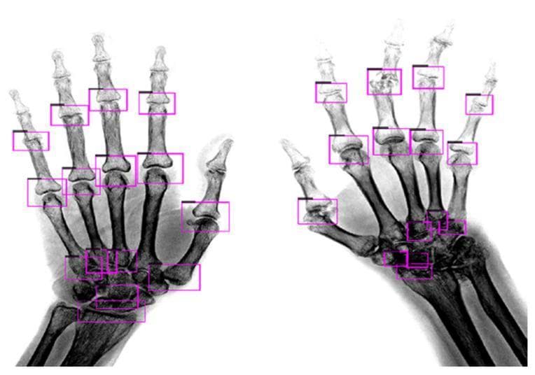 This diagnostic X-ray image (radiography) displays a comparison between two hands demonstrating different stages of Rheumatoid Arthritis (RA). The left hand represents mild RA, characterized by relatively preserved joint spaces and well-defined cortical margins. In contrast, the right hand illustrates severe RA, showing significant joint space narrowing (JSN), subchondral erosions, and architectural distortion of the bone structures. Both hands are overlaid with purple bounding boxes indicating the automated detection of regions of interest (ROIs) for clinical assessment. These ROIs target the proximal interphalangeal (PIP) joints, metacarpophalangeal (MCP) joints, and carpal bones. The image highlights the progression of RA from clear joint margins and identifiable anatomy to the blurred, eroded, and collapsed structures typical of advanced inflammatory arthritis. This visualization is intended for rheumatology and radiology education, specifically focusing on the application of deep learning algorithms for the detection and scoring of joint damage.