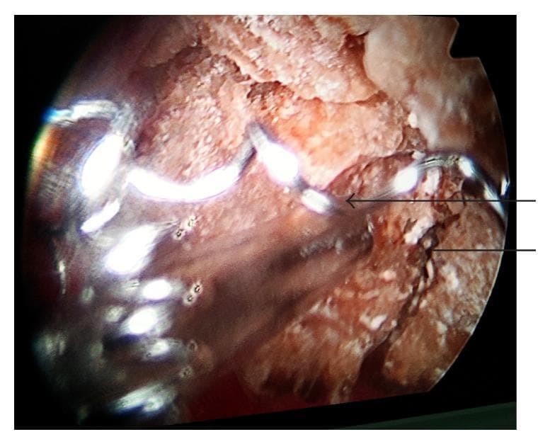 This intraoperative endoscopic image demonstrates a renal pelvic stone undergoing percutaneous nephrolithotomy (PCNL). The stone presents as a large, irregularly shaped, tan-to-brown mass with a rough, crystalline surface texture and focal white deposits. A key pathological feature is a migrated stainless steel embolization coil, visible as a bright, metallic, reflective spiral structure (indicated by an arrow) embedded within the stone matrix. The coil appears to have acted as a nidus for lithogenesis, with calculus material encrusting and engulfing the metallic loops within the pelvicalyceal system. The image illustrates a rare complication where a migrated vascular device facilitates secondary stone formation in the kidney. The surrounding field shows fragmented stone material and the moist internal mucosal environment typical of a urological endoscopic procedure.