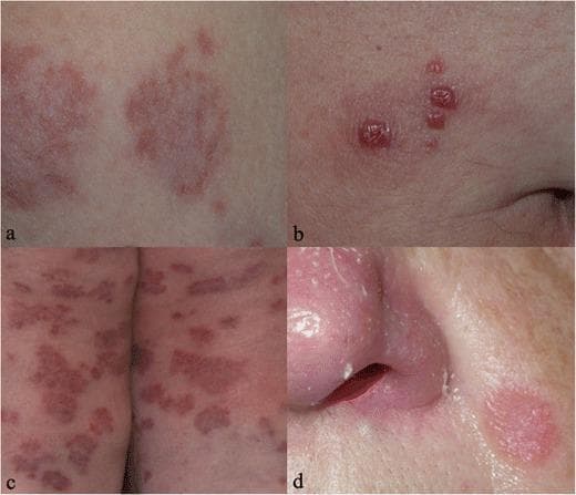 A composite of four clinical photographs (21a–d) demonstrating various cutaneous manifestations of sarcoidosis. Figure 21a illustrates erythema nodosum, characterized by ill-defined, subcutaneous erythematous nodules typically found on the lower extremities. Figure 21b displays 'specific' sarcoid lesions appearing as small, raised, reddish-brown papules with a clustered distribution on the skin. Figure 21c shows extensive involvement with multiple large, annular erythematous plaques that are relatively flat-topped and widely distributed. Figure 21d depicts lupus pernio, a classic clinical sign manifesting as chronic, indurated, violaceous or reddish-pink plaques and papules involving the middle face, specifically the alar rim and tip of the nose, resulting in localized swelling and textural changes. These images provide a comparative overview of the clinical morphology of sarcoidosis, ranging from non-specific reactive lesions to diagnostic granulomatous plaques and papules, supporting medical education in dermatology and internal medicine.