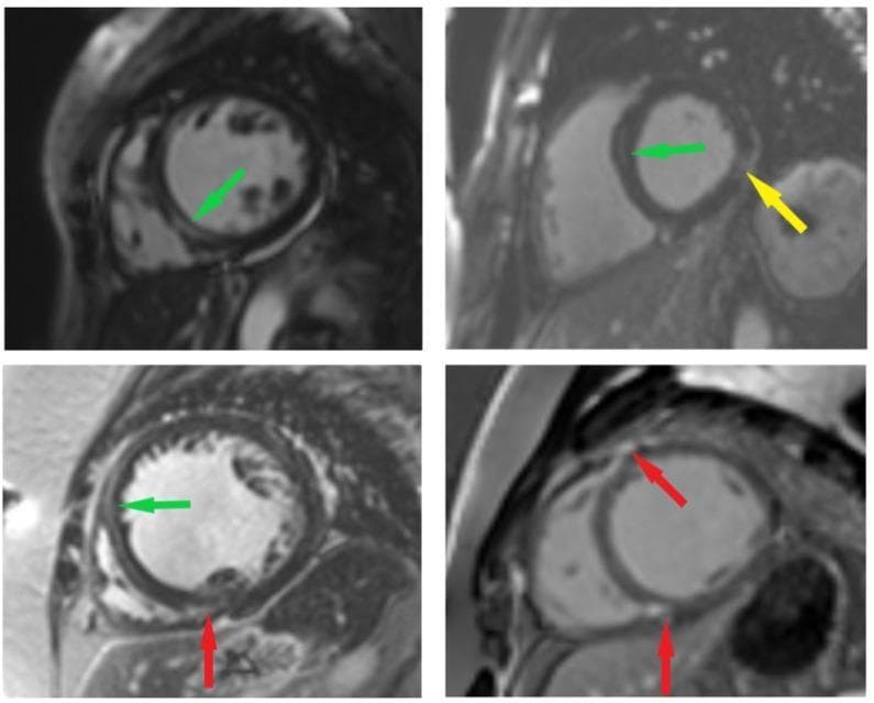 A series of four short-axis cardiac Magnetic Resonance Imaging (MRI) panels demonstrating Late Gadolinium Enhancement (LGE) patterns in patients with non-ischemic dilated cardiomyopathy. These diagnostic images highlight different spatial distributions of myocardial replacement fibrosis. The green arrows indicate a linear mid-wall enhancement pattern, commonly seen in non-ischemic injury. Yellow arrows point to subepicardial enhancement, where high signal intensity is localized to the outer myocardial layer. Red arrows identify RV insertion point enhancement, occurring at the superior and inferior junctions where the right ventricular free wall meets the interventricular septum. Anatomical structures clearly visible include the left ventricle (LV) cavity, the surrounding LV myocardium, and the adjacent right ventricle. These patterns are critical for distinguishing non-ischemic cardiomyopathy from subendocardial ischemic injury and serve as important prognostic indicators for myocardial fibrosis and future cardiac events.