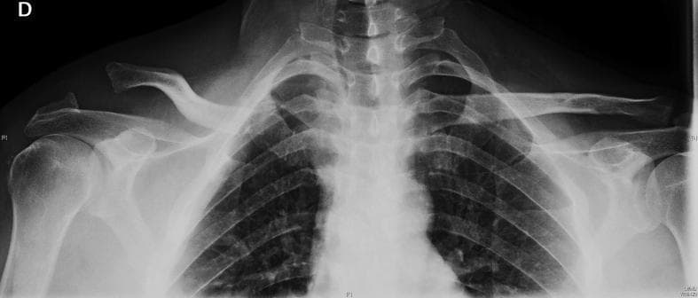 Anteroposterior (AP) chest and shoulder radiograph demonstrating a comparative view of the bilateral acromioclavicular (AC) joints. On the patient's right side, there is a high-grade acromioclavicular joint dislocation (Rockwood type IV) characterized by significant superior and posterior displacement of the distal clavicle relative to the acromion, with an increased coracoclavicular distance. Additionally, there is evidence of an Allman type III fracture of the proximal clavicle and asymmetry at the sternoclavicular region, suggesting a 'floating clavicle' injury pattern (bipolar clavicle injury). The contralateral (left) shoulder exhibits normal anatomical alignment of the acromioclavicular and sternoclavicular joints, serving as a baseline for comparison. This diagnostic image is intended for educational use in orthopedic trauma, illustrating complex clavicular fractures and ligamentous disruptions.