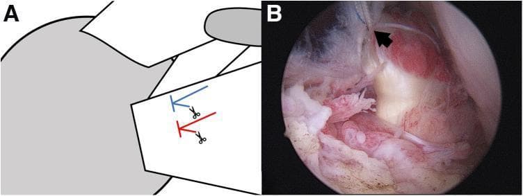 This composite educational graphic details a subscapularis tendon repair technique. Panel A is a simplified schematic diagram illustrating the management of two mattress sutures placed in the tendon stump. Scissor icons indicate the cutting of one limb from each mattress suture, while blue and red lines represent the remaining limbs retained for further repair stages. Panel B is an intra-operative arthroscopic photograph showing the corresponding surgical view within the shoulder joint. A black arrow in Panel B points to the two retained white, braided suture limbs emerging from the repaired subscapularis tendon. The surgical field displays the reddish-pink, fleshy texture of the tendon stump anchored to the lighter-colored bony footprint of the lesser tuberosity. This visual aids in understanding complex suture management during arthroscopic rotator cuff repair, specifically the transition between primary tendon fixation and subsequent suture bridging or comma tissue repair.