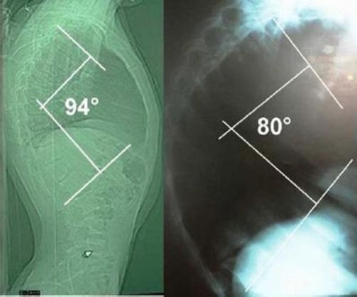 Comparison of two lateral diagnostic X-ray images of the thoracic spine demonstrating significant hyperkyphosis. The left image shows a more severe sagittal plane deformity with a Cobb angle measurement of 94°, indicating a pronounced thoracic curvature. The right image shows a slightly improved but still abnormal kyphotic curvature measured at 80°. Both images utilize white anatomical landmarks and intersecting lines to illustrate the measurement of the thoracic kyphosis angle. The radiographs display the vertebral bodies of the thoracic and upper lumbar regions, highlighting the degree of anterior wedging or postural deviation contributing to the deformity. Clinically, such images are used in orthopedics and neurosurgery to assess the severity of spinal conditions like Scheuermann's disease, neuromuscular kyphosis, or compensatory changes related to spinal lesions or cysts. The visual comparison serves as an educational tool for monitoring disease progression or postoperative correction in pediatric or adolescent patients.
