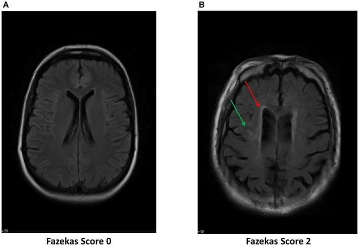 This diagnostic image consists of two side-by-side axial MRI scans of the brain using Fluid-Attenuated Inversion Recovery (FLAIR) sequences, illustrating the Fazekas scale for grading white matter hyperintensities (WMH). Figure A displays a normal brain scan categorized as Fazekas Grade 0, characterized by a homogenous appearance of the white matter with no visible lesions. Figure B displays clinical findings categorized as Fazekas Grade 2, demonstrating moderate leukoaraiosis. Specifically, red arrows highlight periventricular hyperintensities (caps or 'halos' surrounding the lateral ventricles), while green arrows point to punctate or beginning confluent hyperintensities within the deep white matter. These visual markers represent pathological tissue changes such as demyelination, gliosis, and axonal loss, often associated with small vessel disease, age-related cognitive decline, or risk factors for postoperative delirium (POD). The comparison serves as an educational tool for neuroradiological assessment of white matter disease progression and cerebral vascular health.