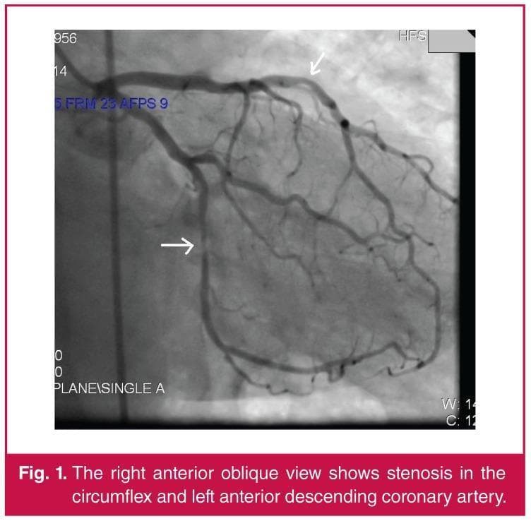 This diagnostic image is a coronary angiogram captured in a Right Anterior Oblique (RAO) view, visualizing the left coronary artery system. The angiogram utilizes radiopaque contrast media to delineate the vascular anatomy. Two primary vessels are highlighted: the Left Anterior Descending (LAD) artery and the Left Circumflex (LCx) artery. The LAD courses along the top portion of the frame with several diagonal branches, while the LCx descends and branches toward the left lateral aspect of the heart. Clinical pathology is indicated by marked stenotic lesions. A white arrow points to a significant area of narrowing (stenosis) in the proximal-to-mid LAD, and a second arrow highlights focal stenosis within the circumflex artery. The image demonstrates the diagnostic utility of invasive angiography in identifying coronary artery disease and assessing the severity of atherosclerotic luminal narrowing. This visual serves as an educational example of obstructive coronary artery disease requiring clinical intervention such as fractional flow reserve (FFR) assessment or percutaneous coronary intervention.
