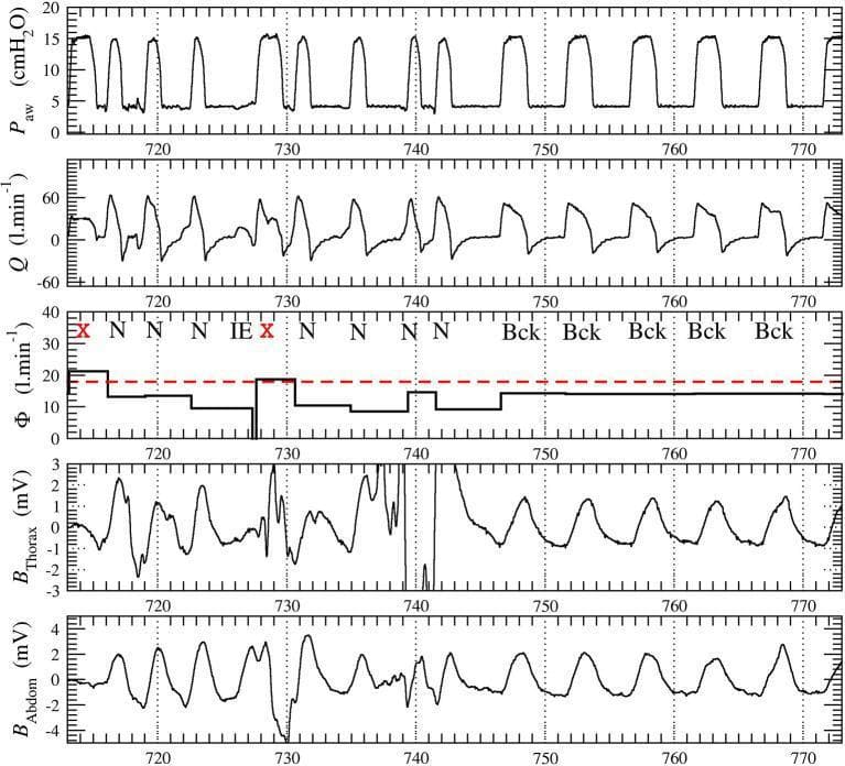 This physiological monitoring waveform chart displays data from a patient receiving non-invasive ventilation (NIV). The display includes five synchronized panels over a 60-second time series (seconds 710 to 775). Top panel: Airway pressure (Paw) measured in cmH2O, showing cyclical ventilatory support peaking at approximately 15 cmH2O. Second panel: Airflow (Q) in l/min, depicting inspiratory and expiratory fluctuations ranging from -30 to 60 l/min. Third panel: Total leakage (ฮฆ) in l/min, shown as a stepwise average per cycle with a red dashed threshold line at 18 l/min; cycles exceeding this (marked with 'X') indicate excessive leakage and turbulent flow. The panel also includes automated event annotations: 'N' (Normal), 'IE' (Ineffective Effort), and 'Bck' (Background/different physiological state). Bottom panels: Thoracic (Bthorax) and abdominal (Babdom) respiratory belt signals in millivolts (mV), demonstrating chest wall and abdominal excursions. These signals are used to assess patient-ventilator synchrony and identify asynchrony events like ineffective efforts or autotriggering. This content is used for educating healthcare providers on ventilator waveform analysis and automated scoring algorithms for patient-ventilator interaction.
