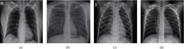 A comparison chart featuring four posterior-anterior (PA) chest X-ray (CXR) samples demonstrating different pulmonary conditions. (a) COVID-19: Shows bilateral, faint ground-glass opacities primarily localized in the lower lung zones. (b) Tuberculosis: Displays significant focal opacity and consolidation in the left upper lung field, suggestive of cavitation or active apical infection. (c) Viral Pneumonia: Exhibits diffuse patchy opacities and areas of consolidation, notably in the right upper and middle lung fields. (d) Normal: Presents as a baseline control with clear lung fields, sharp costophrenic angles, and a normal cardiomediastinal silhouette. The diagnostic images highlight key radiological differences in opacity distribution and morphology between these infectious diseases. This comparison is used to train and evaluate machine learning models for automated respiratory disease classification. The mediastinal structures and heart sizes appear within normal limits across all four examples for comparative purposes.