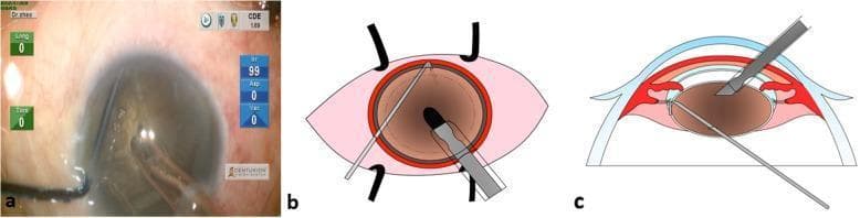Educational panel illustrating the initial step of a phacoemulsification procedure for cataract surgery, consisting of an intraoperative screenshot (a) and corresponding schematic diagrams in front (b) and lateral (c) views. The visuals demonstrate the 'embedding' technique where a phaco tip, protected by a sleeve, is inserted through a circular capsulorhexis (rhexis) into the lens nucleus. The entry point of the metallic phaco tip is positioned slightly axial to the rhexis margin, allowing the distal end of the tip to penetrate toward the central, densest portion of the brown, opaque nucleus. The diagrams clearly delineate the anatomical relationships between the cornea, iris, anterior capsule opening, and the lens. This visual guide is designed for ophthalmology trainees to understand the spatial orientation and instrument depth required to achieve firm holdability of a dense cataract nucleus prior to mechanical chopping. The lateral schematic (c) specifically highlights the angle of approach, ensuring the tip remains within the safe margins of the lens to avoid posterior capsule rupture.