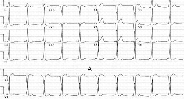 This Comparison Chart consists of two 12-lead electrocardiogram (ECG) tracings (Panel A and Panel B) demonstrating ventricular pre-excitation patterns characteristic of Wolff-Parkinson-White (WPW) syndrome. The primary educational focus is the localization of accessory pathways based on delta wave morphology. Panel A displays a patient with an anteroseptal accessory pathway, characterized by a short PR interval and wide QRS complexes with distinct slurred upstrokes. Specifically, delta waves are strongly positive in inferior leads (II, III, and aVF) and isoelectric to negative in lead V1. Panel B presents an ECG from a patient where the accessory pathway was successfully ablated in the supravalvular aortic cuspal region. Similar to Panel A, the inferior leads (II, III, aVF) show positive delta waves; however, lead V1 exhibits a slightly positive delta wave, distinguishing it from a true septal pathway. These images serve as a clinical diagnostic reference for electrophysiology, illustrating how subtle variations in precordial lead polarity can differentiate between septal and non-septal (paraseptal) accessory pathway locations.
