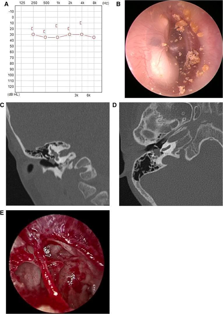 A multi-panel clinical figure documenting a case of Stage II Congenital Middle Ear Cholesteatoma (CMEC). Panel A presents a preoperative audiogram showing mild conductive hearing loss. Panel B is an endoscopic view of the right tympanic membrane, revealing a characteristic opaque, white mass located behind the posterior-superior and inferior quadrants, accompanied by surface keratinous debris. Panels C and D are high-resolution computed tomography (CT) scans of the temporal bone in coronal and axial views, respectively. These demonstrate a soft-tissue density localized within the middle ear cavity without evidence of mastoid air cell involvement or significant bony erosion. Panel E shows an intraoperative endoscopic view after complete surgical excision, confirming an intact ossicular chain. This compilation illustrates the diagnostic triad of pediatric CMEC: audiometric assessment, characteristic otoscopic white reflex (leukocoria of the ear), and radiological localization for surgical planning.