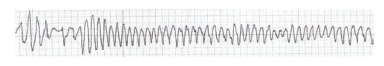 This diagnostic image is an electrocardiogram (ECG) rhythm strip illustrating Torsades de Pointes (TdP), a specific form of polymorphic ventricular tachycardia. The tracing demonstrates a characteristic 'twisting' morphology of the QRS complexes around the isoelectric baseline. Key visual features include a rapid, irregular rate with QRS complexes that continuously vary in amplitude, polarity, and morphology. The rhythm exhibits cyclical oscillations where the peaks of the complexes appear to spiral around the baseline, alternating between larger and smaller deflections. This finding is a critical clinical indicator of a medical emergency often associated with prolonged QT intervals. The image serves as a quintessential educational example for medical students and clinicians to recognize malignant ventricular arrhythmias in cardiology and emergency medicine contexts.