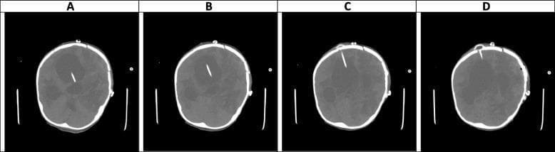 This composite diagnostic image consists of four non-contrast axial CT scans of the brain (labeled A-D), demonstrating significant neurosurgical and pathological findings on day 44 of clinical monitoring. The primary finding is severe, marked hydrocephalus characterized by massive dilatation of the lateral ventricles, including the temporal horns, as well as the third and fourth ventricles. This ventricular enlargement results in substantial compression of the surrounding brain parenchyma. An external ventricular drain (EVD) is visible as a linear, radiopaque structure traversing the right frontal lobe and terminating within the right lateral ventricle, most clearly seen in panels A and B. Multiple ill-defined hypodense areas within the white matter are suggestive of abscess formation or cerebritis. The imaging illustrates a 'communicating' or 'non-communicating extra-ventricular' type of hydrocephalus, likely persistent despite the EVD, suggesting potential drain malfunction or high severity of the underlying condition. The scan also shows evidence of previous craniotomy with associated calvarial defects.