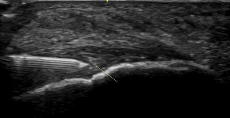 A diagnostic ultrasound image of the distal Achilles tendon in a long-axis view, illustrating an ultrasound-guided injection procedure. The Achilles tendon appears pathologically thickened with a heterogeneous, predominantly hypoechoic texture, consistent with insertional Achilles tendinopathy (IAT). Distinct anechoic voids and hyperechoic calcifications are visible near the tendon's insertion on the calcaneus. A hyperechoic needle is visualized using a long-axis, in-plane approach, with the tip (indicated by an arrow) positioned within the substance of the tendon. The procedure demonstrates a targeted injection (such as Botulinum toxin A or PRP) into the area of maximal tendinopathic change. The image serves as an educational example of musculoskeletal ultrasound intervention, showing real-time needle tracking and the characteristic sonographic features of chronic tendon degeneration.