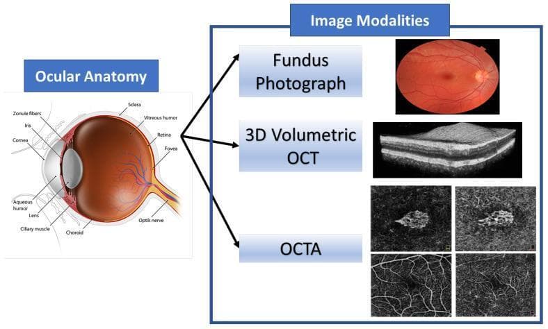 This educational graphic combines an anatomical diagram of the human eye with corresponding ophthalmic imaging modalities. The 'Ocular Anatomy' section features a detailed sagittal cross-section identifying key structures: the cornea, aqueous humor, iris, pupil, biconvex lens, zonule fibers, and ciliary muscle in the anterior segment; and the vitreous humor, retina, fovea, choroid, sclera, and optic nerve in the posterior segment. The 'Image Modalities' section illustrates diagnostic tools used to visualize these structures. A color Fundus Photograph provides a surface view of the retina, optic disc, and vasculature. A 3D Volumetric Optical Coherence Tomography (OCT) scan displays a high-resolution, grayscale cross-sectional view of retinal layers, highlighting tissue stratification. Finally, Optical Coherence Tomography Angiography (OCTA) panels show non-invasive, depth-resolved images of the retinal and choroidal microvasculature. This composite serves as a reference for correlating anatomical landmarks with clinical diagnostic imaging used in the management of retinal diseases such as Age-related Macular Degeneration (AMD).
