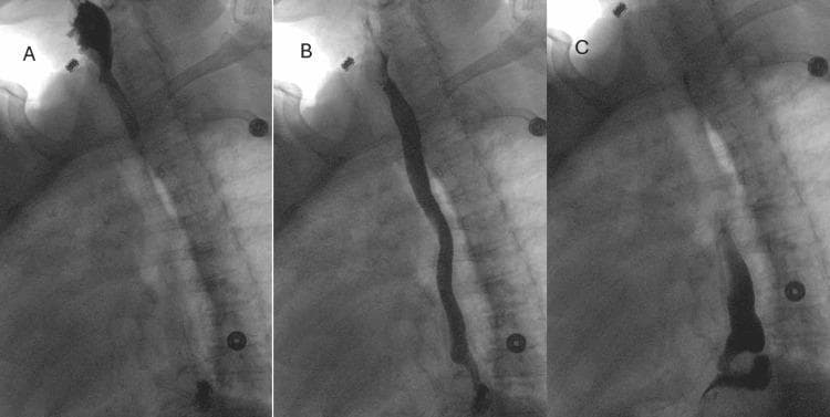 A three-panel figure (A, B, C) showing an upper gastrointestinal (GI) series using fluoroscopic barium contrast. Panel A demonstrates a moderate paraesophageal hernia, characterized by the pooling of radio-opaque barium within a herniated portion of the gastric fundus located above the diaphragmatic hiatus. Panel B illustrates the esophagus filled with barium, showing evidence of mild dysmotility and a small outpouching suspicious for a pulsion diverticulum in the mid-to-distal esophageal segment. Panel C captures an instance of gastroesophageal reflux, where barium contrast is seen retrograde in the distal esophagus above the gastroesophageal junction. The images provide clinical evidence of anatomical and functional abnormalities of the upper GI tract, including hiatal herniation and impaired sphincter or motility function. External cardiac monitoring leads are visible as circular radio-opaque markers on the thorax.
