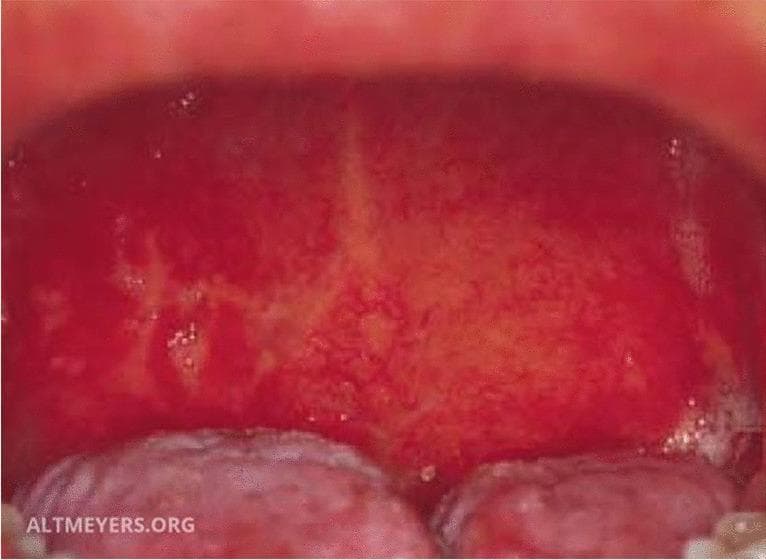 This clinical photograph displays a detailed intraoral view of the posterior oral cavity and oropharynx, demonstrating classic signs of Herpes simplex virus (HSV) stomatitis. The oral mucosa exhibits diffuse, intense erythema (redness) across the soft palate and pharyngeal wall. Superimposed on this inflamed background are multiple irregular, yellowish-white exudative patches and small fibrin-covered erosions, which represent ruptured vesicles characteristic of herpetic infection. The lesions are unevenly distributed and show a tendency toward confluence in certain areas. In the lower foreground, segments of the dorsal tongue are visible; these appear relatively spared, presenting a pale pink color and normal surface texture without obvious ulceration. This image serves as a clinical reference for primary herpetic gingivostomatitis or secondary HSV stomatitis, highlighting the transition from viral vesicles to painful mucosal erosions and the associated generalized inflammatory response in the epithelial tissues.