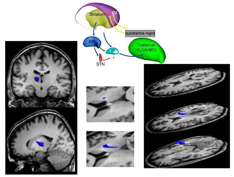 This composite educational graphic details the neuroanatomy and connectivity of the basal ganglia network, specifically focusing on the fronto-striatal circuit. It consists of a functional schematic diagram paired with MRI diffusion tractography images. The schematic illustrates key nodes including the Striatum (containing D1 and D2 pathways), Substantia Nigra, Thalamus (VL/VA/MD nuclei), Globus Pallidus (EP/IP), and the Subthalamic Nucleus (STN). Arrows indicate excitatory and inhibitory pathways, highlighting the indirect and direct pathways of motor control relevant to Parkinson's disease. The accompanying MRI panels (coronal, sagittal, and axial views) show white matter fiber reconstruction using tractography. These panels visualize axonal connections between the striatum and thalamic nuclei, color-coded in blue and yellow to represent distinct fiber bundles. The resource is designed to teach the neurobiological basis of extrapyramidal signs and the localization of basal ganglia dysfunction in clinical neurology.