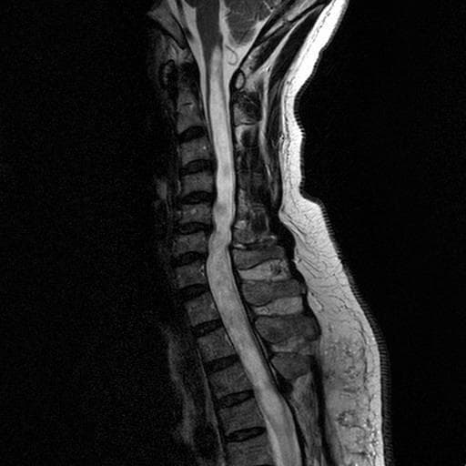 This diagnostic image is a T2-weighted sagittal MRI of the cervical spine, demonstrating a significant longitudinal syrinx (syringomyelia). The spinal cord is centrally located within the spinal canal and shows a large, well-defined, tubular hyperintense signal (indicating cerebrospinal fluid content) extending from the cervicomedullary junction through the cervical levels. The syrinx causes focal expansion of the spinal cord diameter at several levels. Anatomical landmarks include the rectangular vertebral bodies anterior to the cord and the visible posterior elements. Notably, the high-intensity fluid signal within the cord is distinct from the surrounding gray and white matter parenchyma. The superior margin of the syrinx is visualized near the obex of the medulla, but there is no direct communication with the fourth ventricle. The image serves as a clinical illustration of cervical syringomyelia and its impact on spinal cord morphology, essential for neurosurgical and neurological education.