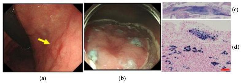 This composite image illustrates the clinical and histopathological findings of Epstein-Barr virus-associated gastric cancer (EBVaGC). Panel (a) shows an ordinary endoscopic view of the middle gastric body, identifying a superficial depressed-type early gastric cancer lesion (indicated by a yellow arrow). Panel (b) depicts the lesion during endoscopic submucosal dissection (ESD) using en bloc resection. Panel (c) is a low-power microscopic view of the H&E-stained ESD specimen, demonstrating submucosal invasion (0.8 mm) and a carcinoma with lymphoid stroma (CLS) pattern without lymphovascular involvement. Panel (d) shows a high-power microscopic view using EBER-1 in situ hybridization (ISH); the tumor cell nuclei exhibit strong positive (dark) staining for EBV-encoded RNA, while surrounding tumor-infiltrating lymphocytes (TILs) and non-cancerous gastric epithelium remain negative. This case demonstrates the diagnosis and therapeutic evaluation of EBVaGC, emphasizing the use of ISH for definitive classification in early-stage mucosal lesions.