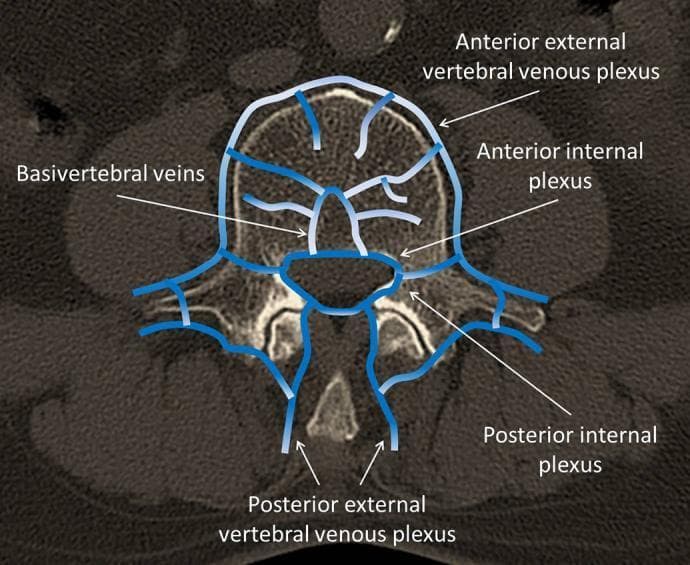 Anatomical Diagram overlaid on a computerized tomography (CT) cross-section of a human vertebra, illustrating the vertebral venous plexuses. The axial view displays four primary venous networks labeled with blue schematics: the anterior external vertebral venous plexus, which lies on the anterolateral surface of the vertebral body; the posterior external vertebral venous plexus, located around the vertebral arches and spinous process; and the internal plexuses (anterior and posterior) situated within the spinal canal. Centrally, the basivertebral veins are shown originating within the vertebral body and draining into the internal vertebral venous plexuses. The diagram highlights the complex, interconnected nature of the spinal venous system, which is clinically significant in understanding the potential pathways for Batson's plexus and the risk of cement embolism during spinal procedures like balloon kyphoplasty (BKP). This content is intended for intermediate medical education, focusing on spinal anatomy and perioperative complications.