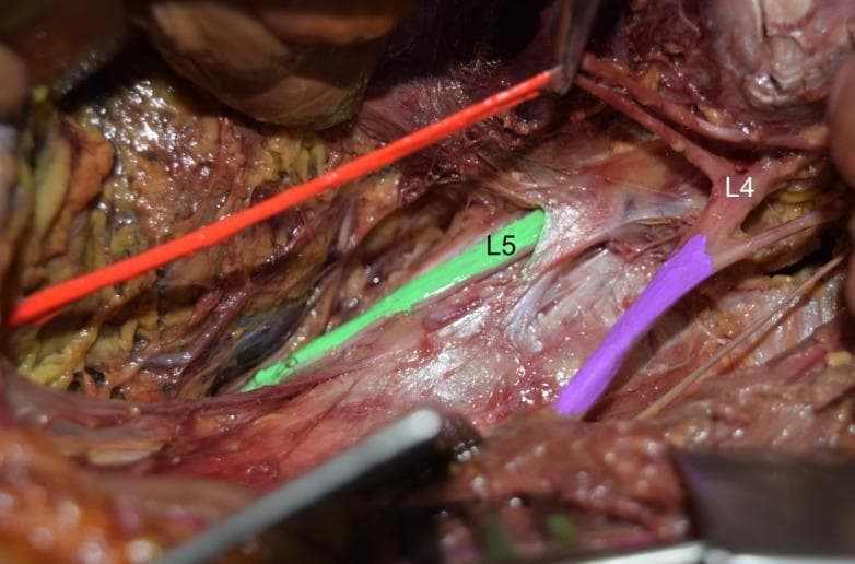 Anatomical Diagram/Clinical Photograph: This image depicts a cadaveric dissection of the left posterior abdominal wall focusing on the lumbar plexus. The psoas major muscle has been removed to expose the neural structures. Key anatomical landmarks are color-coded for clarity: the L4 ventral ramus and femoral nerve are highlighted in purple, the L5 ventral ramus is highlighted in green, and the obturator nerve is shown in orange/red. The primary educational focus is an anatomical variation where the lumbosacral trunk is absent. Visually, there is a clear separation between the L4 and L5 ventral rami, with no evidence of the standard fusion that typically forms the lumbosacral trunk. The femoral nerve (purple) is seen emerging from the L4 level, running lateral and parallel to the L5 ramus (green). This clinical photograph serves as an educational tool for gross anatomy and neurosurgery, illustrating variations in lumbosacral plexus connectivity and its implications for regional anesthesia or surgical approaches to the pelvic and lumbar regions.