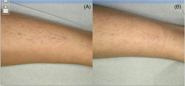 This clinical photograph series is a comparison chart showing the dermatological response to treatment for leg telangiectasia. Image A (baseline) displays a prominent network of fine, branching, dark red and purple vascular lesions on the skin of the lower limb, characteristic of spider veins or telangiectasia. These vessels are sharply defined and show a dense distribution across the cutaneous surface. Image B (6 months post-treatment) illustrates significant clinical improvement, showing the near-complete disappearance of the distinct vascular network. The skin appears smoother with only residual faint erythema or subtle hyperpigmentation where the vessels were previously located. The comparison demonstrates the efficacy of therapeutic intervention (such as sclerotherapy or laser treatment) in reducing the visible manifestation of superficial vascular ectasias. This visual is relevant for dermatology and vascular medicine, specifically for educating on the management of chronic venous insufficiency signs and aesthetic vascular procedures.