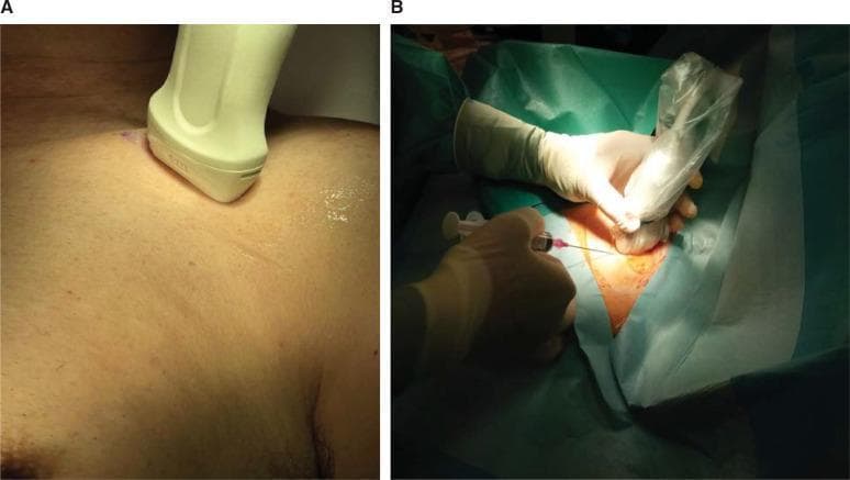 Two-panel clinical photograph demonstrating the technical setup for ultrasound-guided axillary vein cannulation. Panel A (left) shows a close-up of a linear ultrasound transducer positioned on the patient's upper chest/infraclavicular region. The probe is oriented in a transverse (short-axis) plane, perpendicular to the longitudinal axis of the underlying axillary neurovascular bundle, with visible acoustic gel at the skin interface. Panel B (right) depicts the sterile procedural setup. The patient is draped with green surgical sheets, and the clinician, wearing sterile gloves, holds the ultrasound transducer enclosed in a transparent sterile protective sheath. Simultaneously, a needle attached to a syringe is being advanced toward the target vessel using an out-of-plane approach. The images illustrate the ergonomic and spatial relationship between the transducer and needle during central venous access, emphasizing sterile technique and probe positioning for visualization of the axillary artery and vein.