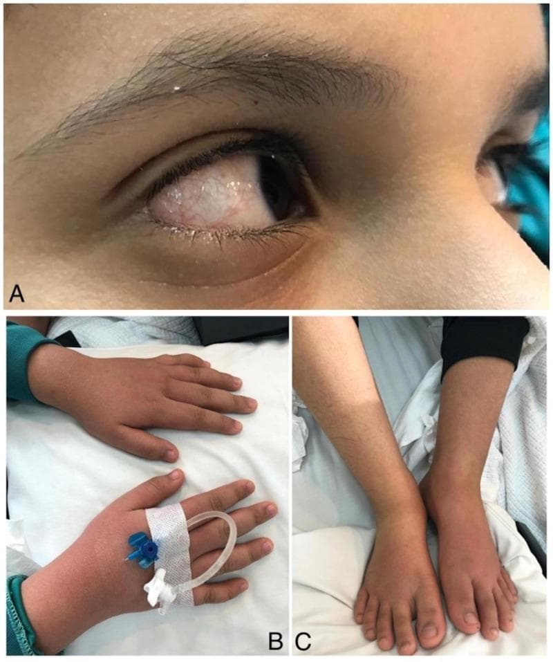 This composite of clinical photographs illustrates classic diagnostic features of Kawasaki Disease in a pediatric patient. Panel A displays a close-up of the eye showing acute, non-purulent bilateral bulbar conjunctival injection. The sclera appears erythematous due to dilated blood vessels, while the cornea remains clear and without exudate. Panels B and C demonstrate symmetrical bilateral edema of the extremities. In Panel B, the dorsal aspects of the hands are visibly swollen (indurative edema), with the skin appearing taut and shiny; an intravenous catheter is secured on the left hand. Panel C shows similar pitting-like edema affecting the feet and ankles. These findings—conjunctival redness and extremity swelling—are key clinical criteria used in the diagnosis of Kawasaki Disease, typically presenting alongside persistent high-grade fever. The images serve as an educational reference for identifying multi-system inflammatory signs in vasculitis.