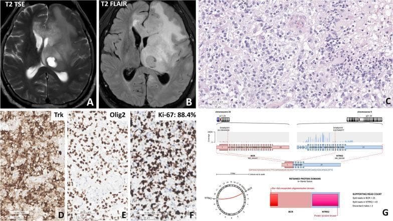 This composite image details the neuroradiological, histopathological, and molecular features of a glioblastoma (IDH-wildtype) harboring a BCR::NTRK2 fusion. (A-B) Axial T2-weighted turbo spin-echo and T2 FLAIR MRIs demonstrate a hyperintense mass involving the thalamus and bifrontal regions with extensive peritumoral edema. (C) H&E staining reveals a cellular tumor composed of oligodendroglioma-like round cells with clear cytoplasm, microvascular proliferation, and areas of pseudopalisading necrosis. (D-F) Immunohistochemical analysis shows diffuse cytoplasmic positivity for TRK, strong nuclear staining for Olig2, and a high Ki-67 proliferative index of 88.4%. (G) An Arriba plot illustrates the molecular findings, identifying an in-frame fusion between chromosome 22 (BCR gene) and chromosome 9 (NTRK2 gene), involving the retention of the protein tyrosine kinase domain. This case exemplifies the integration of advanced imaging, immunohistochemistry, and genomic sequencing for the diagnosis of high-grade NTRK-fused gliomas in neuro-oncology.