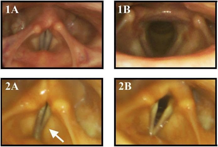 This composite of four flexible endoscopic laryngoscopy images demonstrates vocal fold motion impairment (VFMI) in Multiple System Atrophy (MSA). Figures 1A and 1B serve as healthy controls. During phonation (1A), the true vocal folds show full adduction to the midline; during the sniffing maneuver (1B), they show wide, symmetrical abduction, opening the glottis. In contrast, figures 2A and 2B depict a patient with MSA. During phonation (2A), there is insufficient adduction of the true vocal folds, resulting in a persistent glottal gap, accompanied by compensatory medial activation of the vestibular (false) folds (marked by a white arrow). During the sniffing maneuver (2B), the MSA patient demonstrates incomplete abduction (abductor restriction), where the vocal folds fail to open to the full extent seen in the control. These images illustrate the laryngeal manifestations of neurodegenerative disease, specifically the impairment of both adductor and abductor functions which can lead to dysphonia and stridor.
