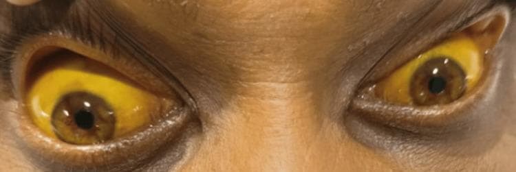 This clinical photograph displays a close-up view of a patient's eyes and upper face, illustrating severe scleral icterus. Both eyes exhibit deep, uniform yellow pigmentation of the sclera and bulbar conjunctiva, a hallmark sign of hyperbilirubinemia. The surrounding facial skin, particularly on the forehead and periorbital regions, also shows a subtle yellowish hue consistent with jaundice, though less pronounced than the ocular findings. The image serves as a clear educational example of the physical manifestations of liver dysfunction, biliary obstruction, or systemic toxicity—in this context, following rodenticide (zinc phosphide) ingestion. The visibility of the distinct yellowing against the patient's natural skin tone provides a significant diagnostic reference for internal medicine and gastroenterology students and practitioners.