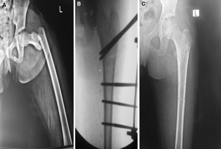 This composite of three radiographic images illustrates the surgical management and progression of a pediatric subtrochanteric femoral fracture. Panel A: Anteroposterior (AP) X-ray of the left hip and proximal femur showing a complete, displaced subtrochanteric fracture. The proximal fragment is abducted and flexed, while the distal femoral shaft is displaced laterally and superiorly (shortened). Panel B: Intraoperative fluoroscopic image demonstrating surgical stabilization using an external fixation system. Multiple radiopaque half-pins are visible: two pins are inserted into the proximal fragment near the greater trochanter, and three pins are secured into the distal femoral shaft, achieving anatomical alignment and reduction. Panel C: Follow-up AP X-ray taken 11 weeks postoperatively after frame removal. The image shows complete cortical bridging and callous formation at the fracture site, indicating successful osseous union and restoration of the mechanical axis of the femur. This series serves as an educational example of pediatric orthopedic trauma management using external fixation for proximal femur fractures.