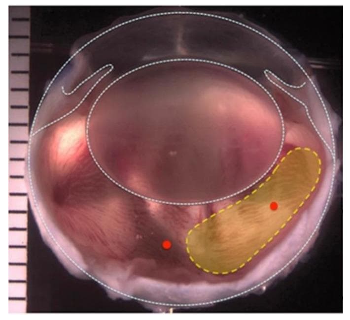 Clinical photograph and annotated diagram of a rabbit (Dutch belted) eye following a two-port partial pars plana vitrectomy. The image illustrates the surgical anatomy of the posterior segment, with the globe demarcated by a dashed white line. A yellow dotted outline highlights an elongated, horizontally oriented region in the temporal vitreous chamber where 0.3–0.4 mL of natural vitreous gel was surgically removed and replaced with a hydrogel-based vitreous substitute (1.5G_10Cop), silicone oil, or balanced salt solution (BSS). The surgical approach involved two 23-gauge trocars inserted 2 mm from the limbus for infusion and vitrector access. The surrounding tissue shows a pinkish-red hue with visible striations, while the replaced vitreous zone appears more opaque and yellowish. This visual documentation supports research into biocompatible vitreous substitutes, evaluating their effects on retinal health, intraocular pressure, and long-term functional stability.