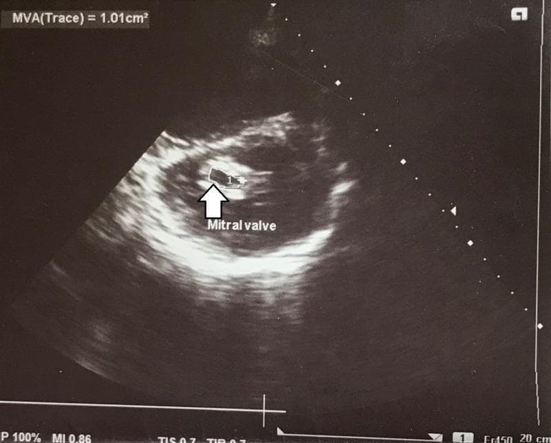 This diagnostic image is a transthoracic echocardiogram (TTE) in a parasternal short-axis view at the level of the mitral valve. The image illustrates severe mitral stenosis, likely of rheumatic etiology, characterized by significantly thickened and echogenic (calcified) mitral valve leaflets. A planimetric measurement of the mitral valve orifice is demonstrated, with the 'MVA(Trace)' value displayed at the top left as 1.01 cm², which falls within the range for severe stenosis. A white arrow and the label 'Mitral valve' highlight the orifice, showing the restricted opening during diastole (the 'fish-mouth' appearance). The image serves as an educational example of cardiac ultrasonography used to quantify valvular disease through direct planimetry. It provides clinical relevance for assessing patients with suspected rheumatic heart disease and correlating hemodynamic data with structural pathology.