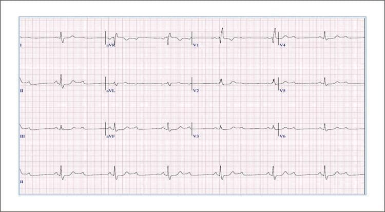 This diagnostic image is a 12-lead electrocardiogram (ECG) with a rhythm strip (Lead II) illustrating complex cardiac conduction disturbances. The primary finding is a Second-Degree Atrioventricular (AV) Block with a 2:1 conduction ratio, characterized by regular P waves occurring at approximately double the frequency of the QRS complexes, where every second P wave fails to conduct to the ventricles. The conducted QRS complexes demonstrate a Right Bundle Branch Block (RBBB) morphology, most prominent in lead V1, which shows an rsR' pattern and wide, slurred S waves in leads I and V6. The ST-segment and T-waves show secondary repolarization changes consistent with the intraventricular conduction delay, including T-wave inversions in the right precordial leads (V1-V3). This ECG is an educational example of exercise-related or recovery-phase conduction system disease, demonstrating the coexistence of AV nodal or infra-nodal block and bundle branch block, which carries clinical significance for potential progression to complete heart block.