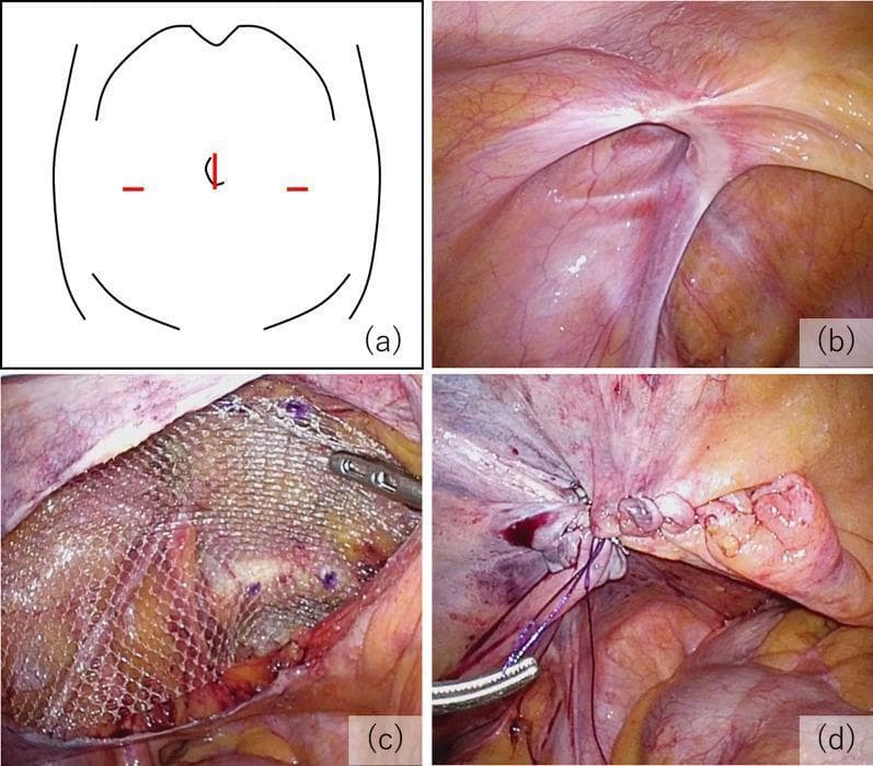 A multi-panel educational figure illustrating the key procedural steps of a Transabdominal Preperitoneal (TAPP) inguinal hernia repair. (a) Schematic diagram of the abdomen showing the laparoscopic port arrangement: a 12 mm umbilical port and two 5 mm lateral ports. (b) Intraoperative laparoscopic photograph showing the internal inguinal anatomy and the hernial orifice, classified as EHS-L2 (European Hernia Society classification for a medium indirect lateral hernia). (c) Surgical view demonstrating mesh fixation; a semi-transparent, macroporous polypropylene mesh is positioned in the preperitoneal space to cover the defect and is secured with visible surgical tacks. (d) Final procedural step showing the closure of the peritoneal flap using continuous suturing to exclude the mesh from the peritoneal cavity, preventing contact with abdominal viscera. The series emphasizes proper anatomical orientation, mesh placement, and peritoneal closure in minimally invasive hernia surgery.