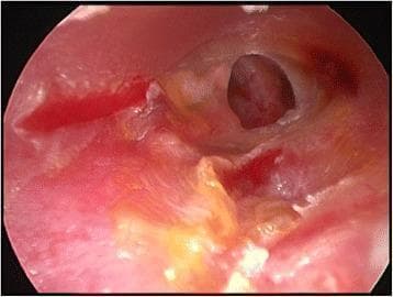 An endoscopic clinical photograph of a left tympanic membrane exhibiting a medium-sized subtotal perforation. The tympanic membrane itself shows signs of significant pathological changes, including diffuse erythema (inflammation) and yellowish discoloration, likely representing tympanosclerosis or chronic inflammatory exudate. The perforation is centrally located with irregular margins, through which the dark middle ear cavity and portions of the promontory are visible. The surrounding external auditory canal tissue is also notably erythematous and hyperemic. There is a small amount of white squamous debris or purulent discharge visible at the inferior portion of the canal. This image serves as a diagnostic visual for chronic otitis media and provides the preoperative anatomical context for surgical interventions such as myringoplasty or tympanoplasty.