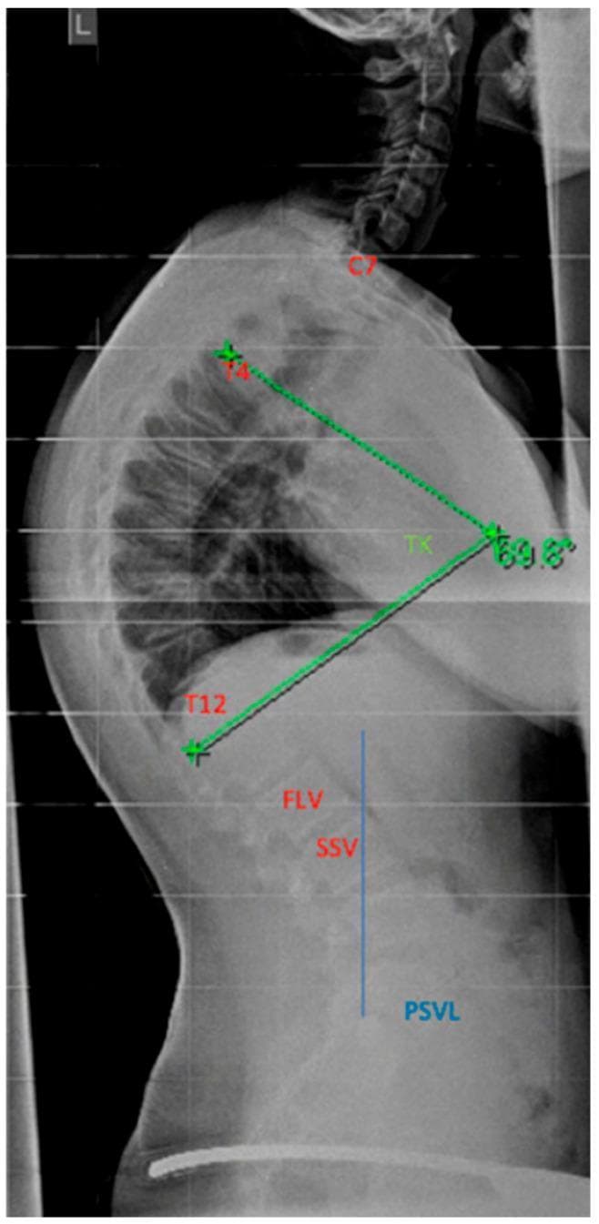 A lateral spinal radiograph demonstrating severe thoracic hyperkyphosis, characteristic of conditions such as Scheuermann's disease. The image shows the full sagittal profile of the spine from the cervical region through the lumbar vertebrae. Anatomical landmarks are labeled in red, including C7, T4, and T12. The thoracic kyphosis (TK) angle is measured using the Stagnara method between the T4 and T12 vertebral bodies, indicated by green lines that quantify the curvature at 69.8 degrees. Further sagittal balance parameters are identified in the lower spine, including the First Lordotic Vertebral body (FLV) and the Sagittal Stable Vertebral body (SSV). A blue vertical reference line marks the Posterior Sagittal Vertical Line (PSVL). This diagnostic imaging is essential for orthopedic assessment, determining surgical instrumentation levels (Upper Instrumented Vertebra and Lowest Instrumented Vertebra), and evaluating the risk of distal junctional kyphosis in pediatric and adolescent spinal deformities.