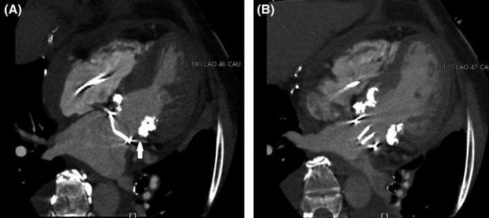 Postoperative multidetector computed tomography (MDCT) scans of the heart in a patient after mitral valve replacement (MVR) for severe mitral stenosis and extensive calcification. Image (A) displays the systolic phase, showing the St. Jude Medical (SJM) bileaflet mechanical valve in a closed position. A white arrow highlights the anatomical relationship where the prosthetic valve is displaced from the posterior mitral annulus due to significant, hyperdense calcification extending toward the left atrium. Image (B) displays the diastolic phase, demonstrating the adequate opening of the mechanical valve leaflets. The MDCT highlights that the prosthetic structure is unobstructed by the subannular apparatus, confirming functional integrity despite severe regional calcification. These cardiac images illustrate complex valve positioning in the presence of extensive annular calcification, relevant for cardiothoracic surgery and diagnostic radiology educational levels.