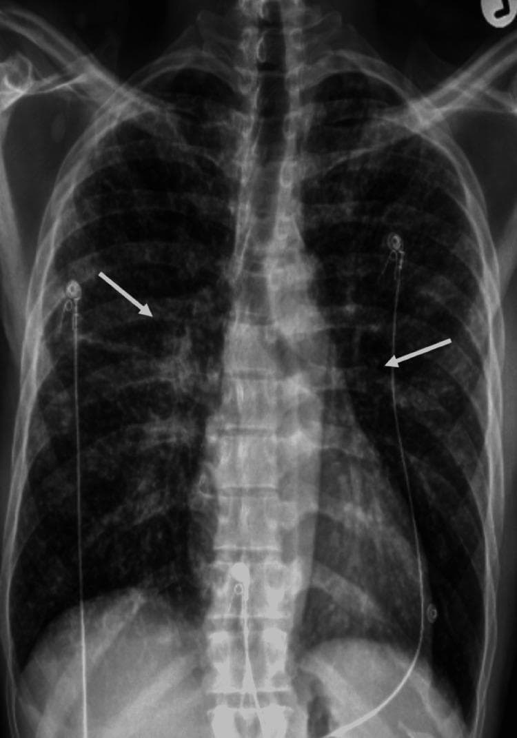 This diagnostic image is an anteroposterior (AP) chest X-ray demonstrating clinical progress in a patient with systemic sarcoidosis. The primary focus is on the bilateral hilar regions, where white arrows indicate a marked reduction in the size and density of hilar lymphadenopathy compared to previous findings. The lung parenchyma shows residual but improved fine reticulonodular opacities, characteristic of granulomatous lung disease. Several medical devices are visible, including ECG monitoring electrodes with wires overlying the thoracic cage and what appear to be central venous catheter lines entering via the subclavian regions. The osseous structures, including the spine and ribs, are visualized, and the cardiac silhouette appears stable. This radiograph serves as an educational example of radiographic response to corticosteroid therapy in a patient presenting with hypercalcemia and noncaseating granulomas.